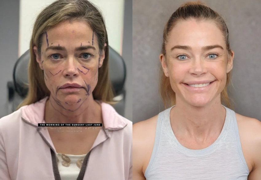 "Выглядит на 15 лет моложе". В сети обсуждают "феноменальный" результат пластической операции 55-летней Дениз Ричардс